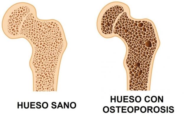 5. Aumentan el riesgo de sufrir osteoporosis