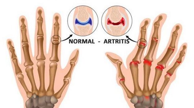 Alivia la artritis y el reumatismo